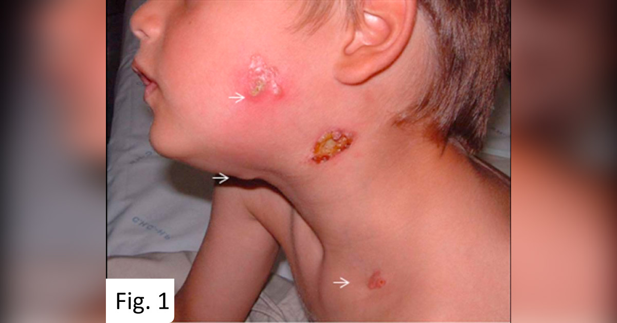A Puzzling Case of Unusual Facial Lesion on a Four-year-old Boy