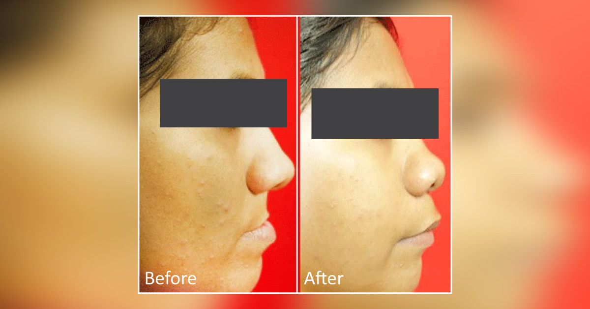What is Anterior Maxillary Distraction or AMD?