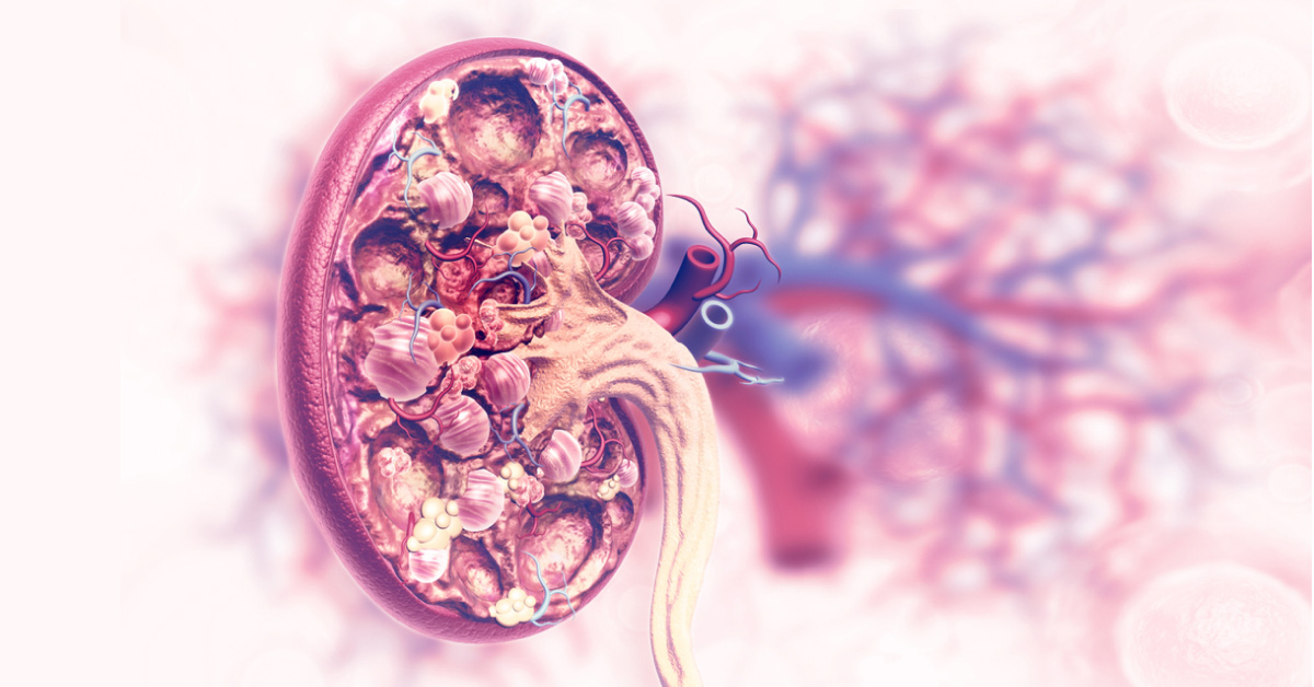 Clinical Presentation of Chronic Kidney Disease