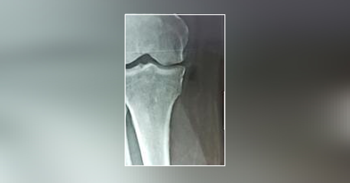 Is There Fracture Or Not? 