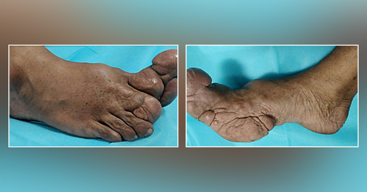 Macrodystrophia Lipomatosa of the Foot