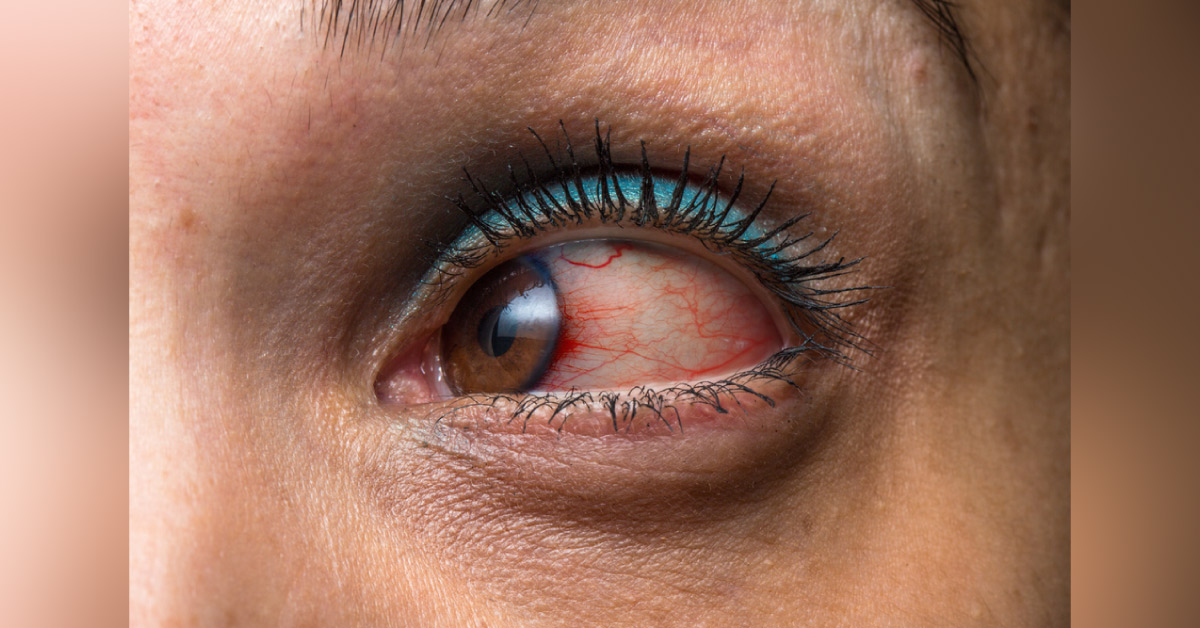 Brief Post On Uveitis Syndromes