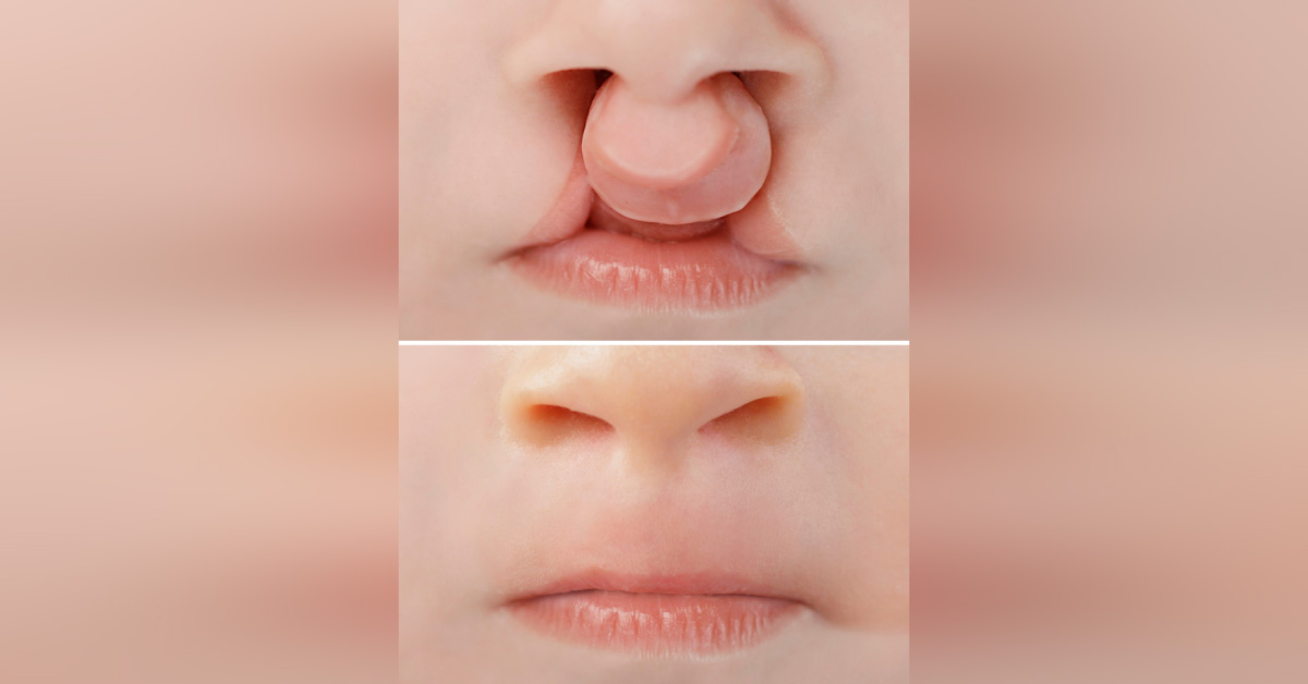 Comprehensive Cleft Care: Why Is A Craniofacial Team Important?