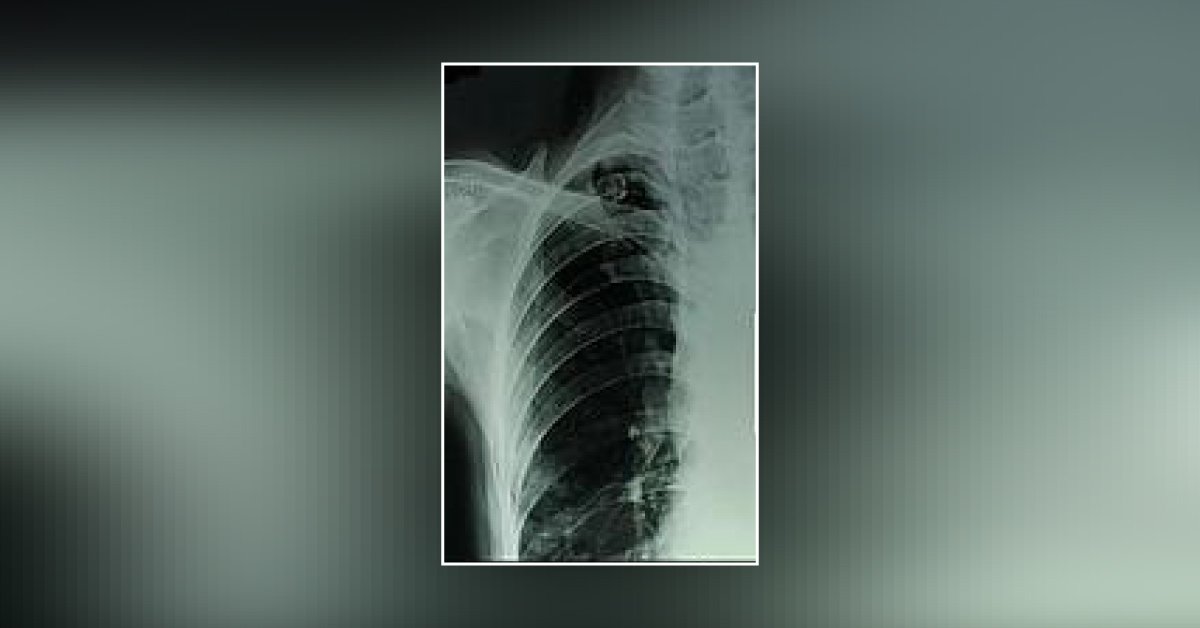 Is It A Calcified And Broken Lymph Node?