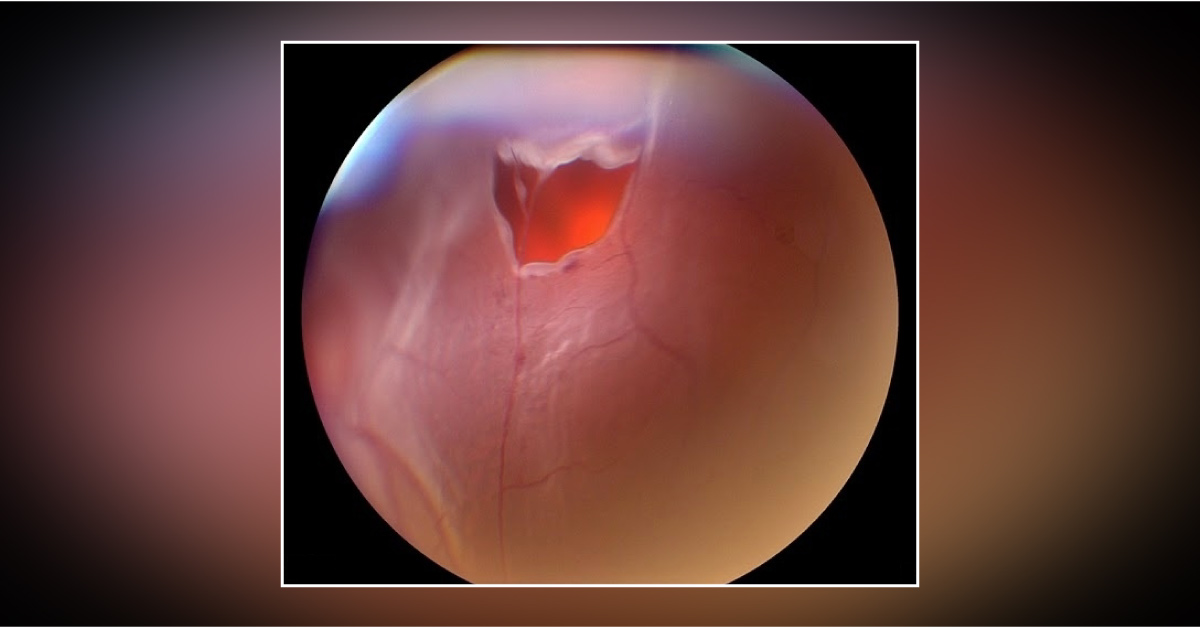 Various Types Of Retinal Holes