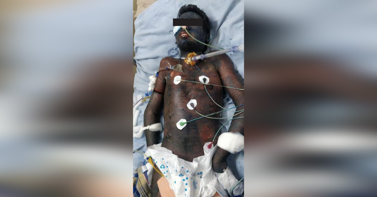 Complaints Of Bilateral Abscess
