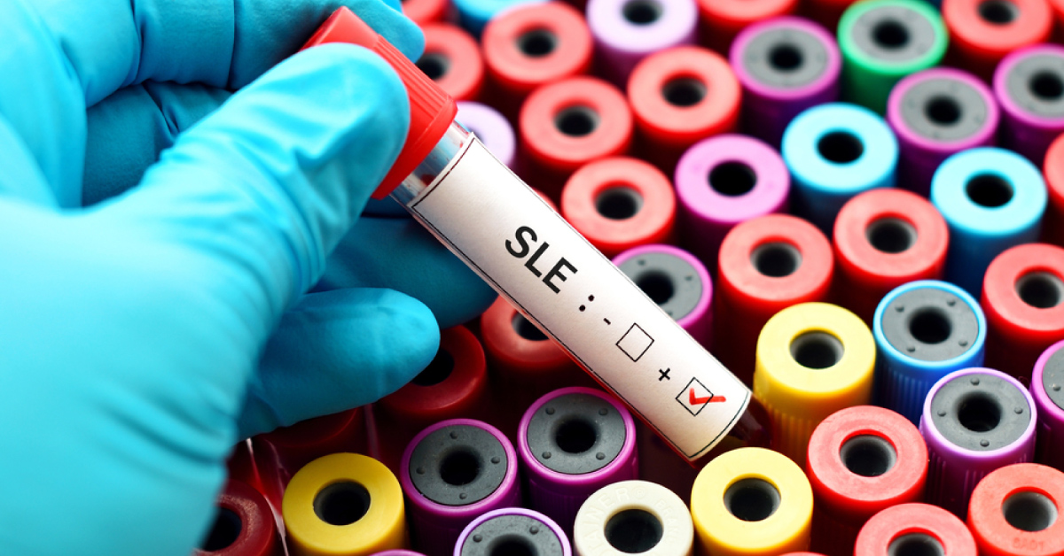 Ocular Manifestations Of SLE