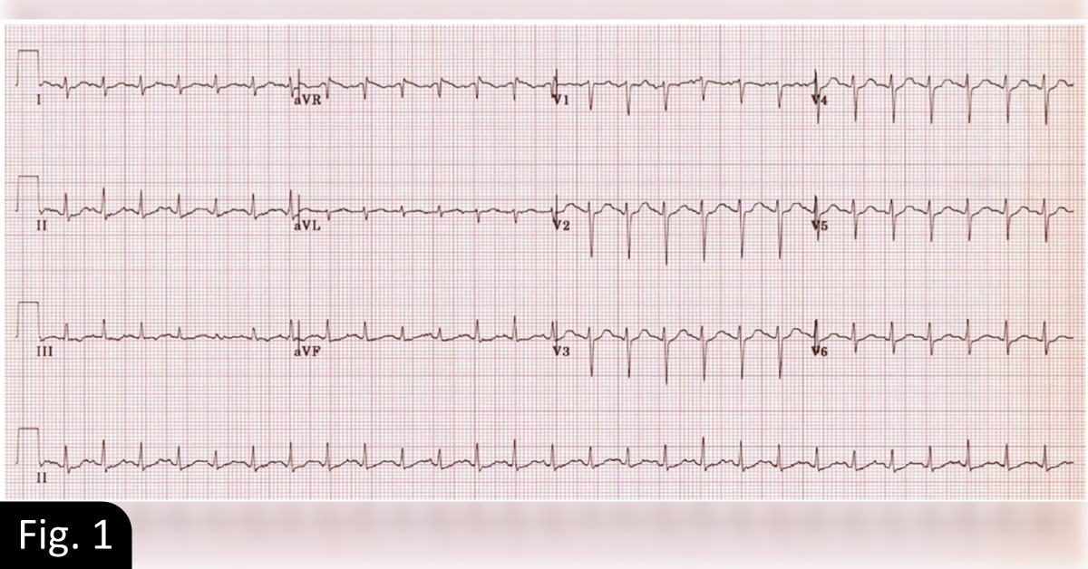 A Geriatric Woman With Fever And Emesis
