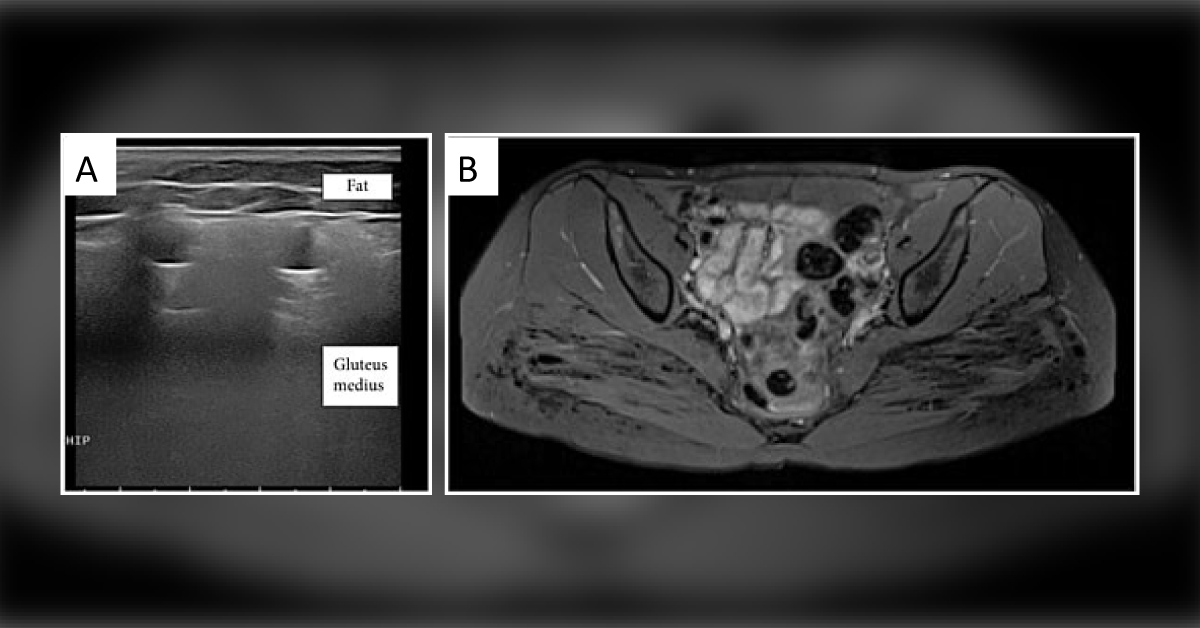 Silicone Induced Posterolateral Hip Pain: An Unusual Diagnosis