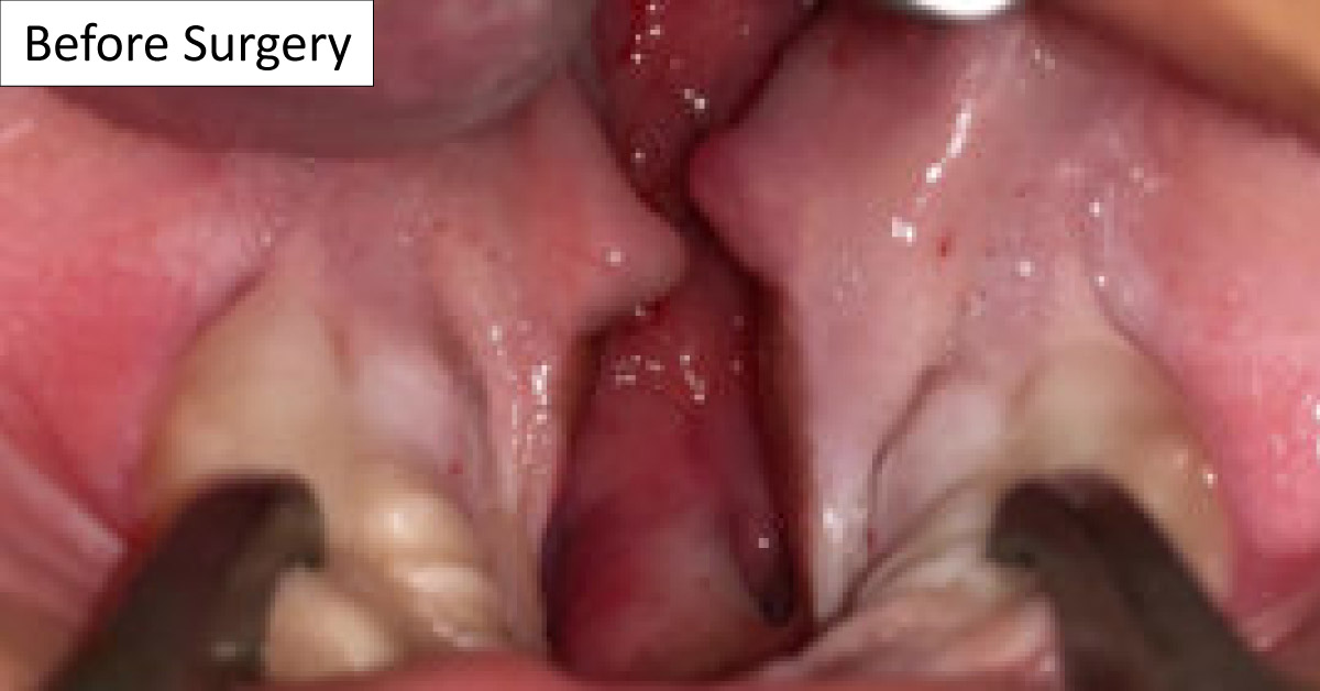 Cleft Palate Treatment