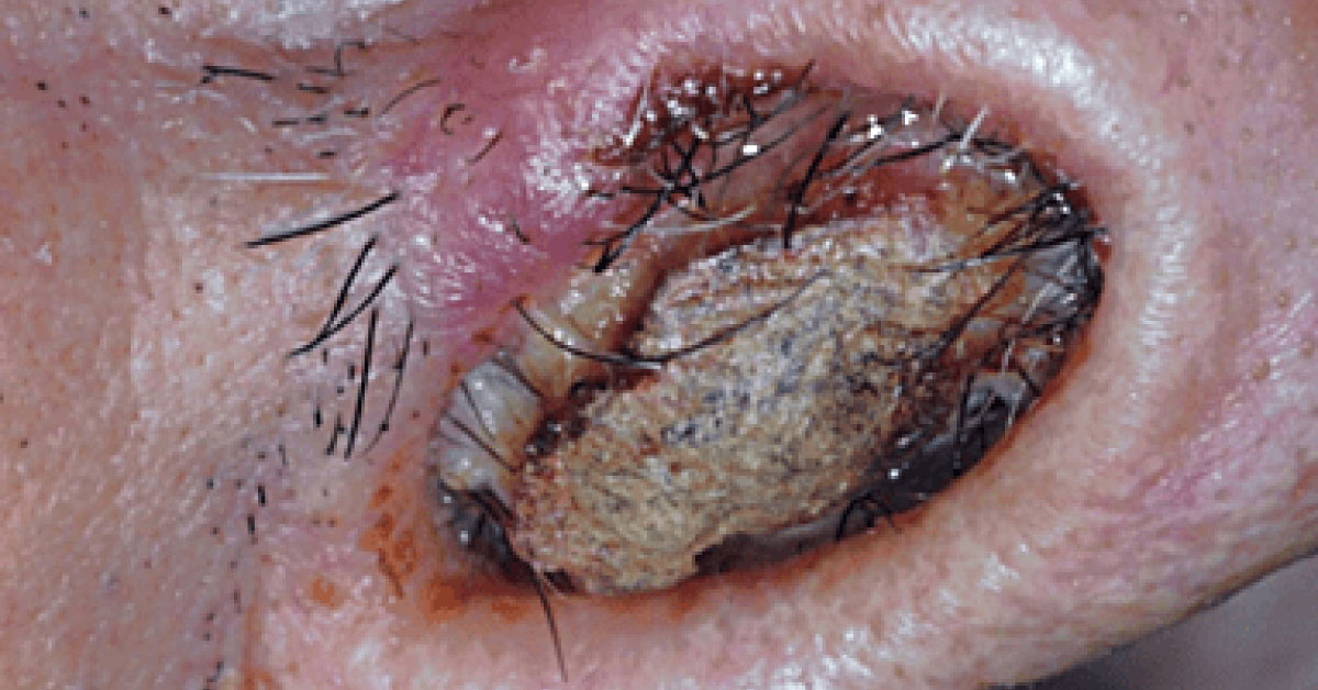 An Unusual Lesion Growing In the Nose
