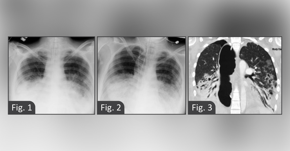 A Rare Case of Aspiration Pneumonia in a 16-year-old Girl