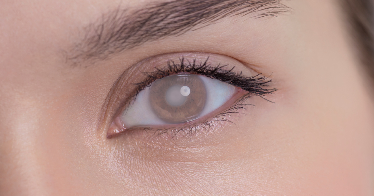 Brief Post On Scleral Lesions