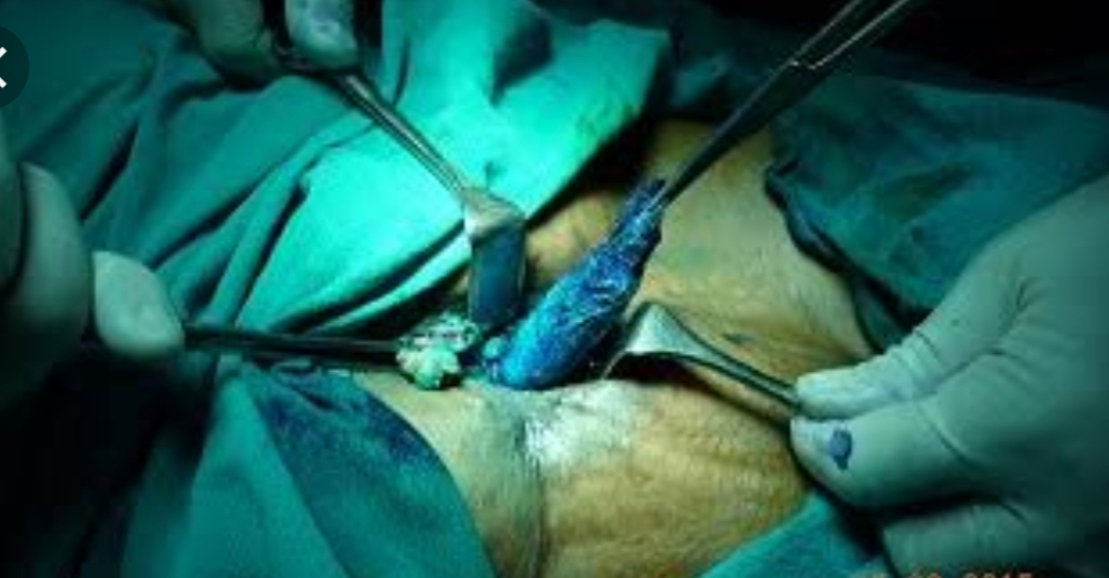 Who Is Negligent When Patient Deny Operation Advised By Doctor