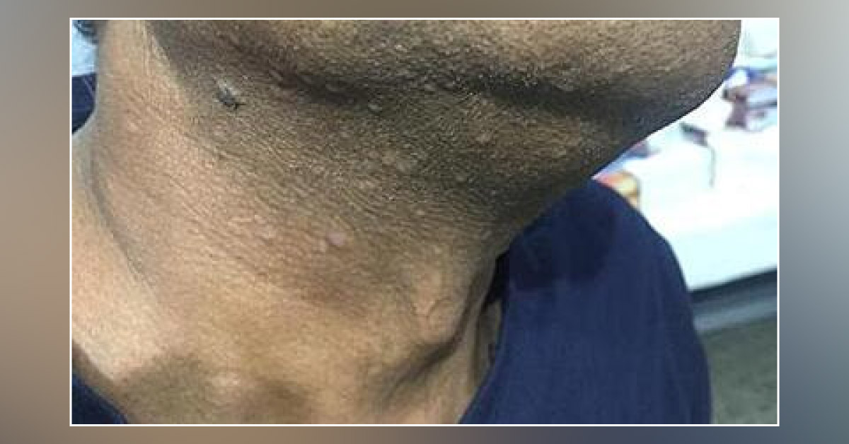What Are These Lesions On Face?