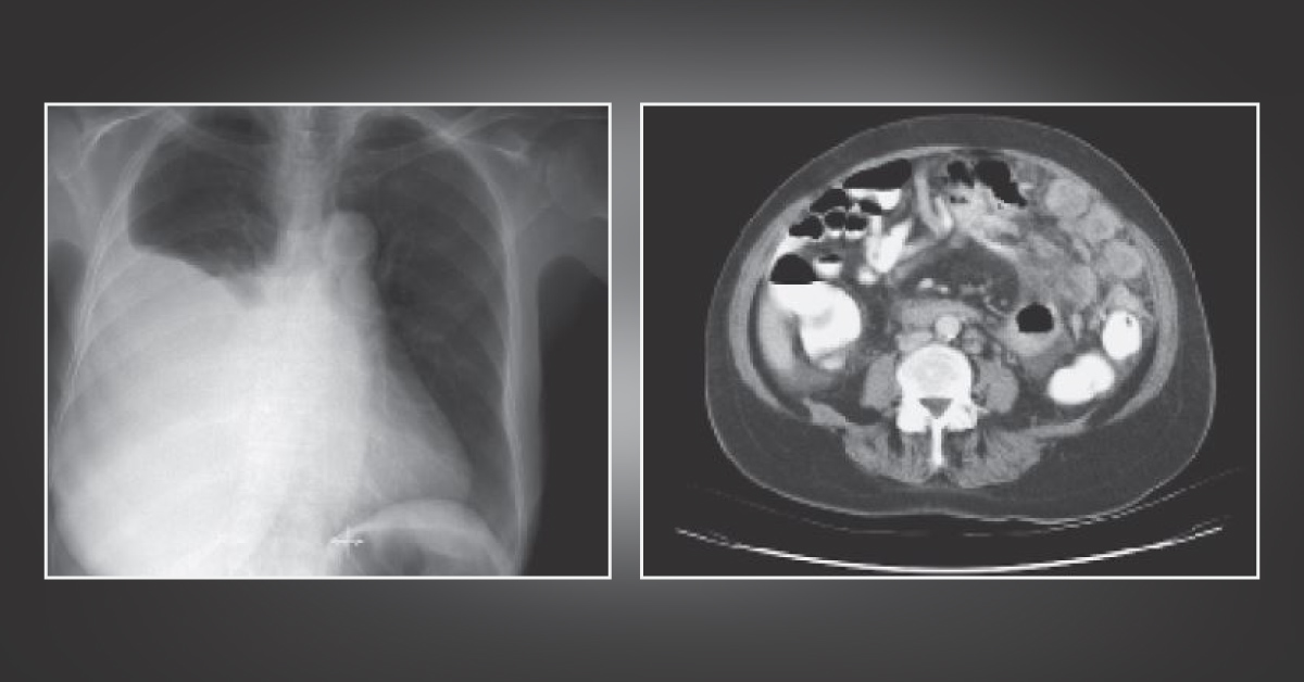 Case of a Geriatric Female with Shortness of Breath and Abdominal Pain