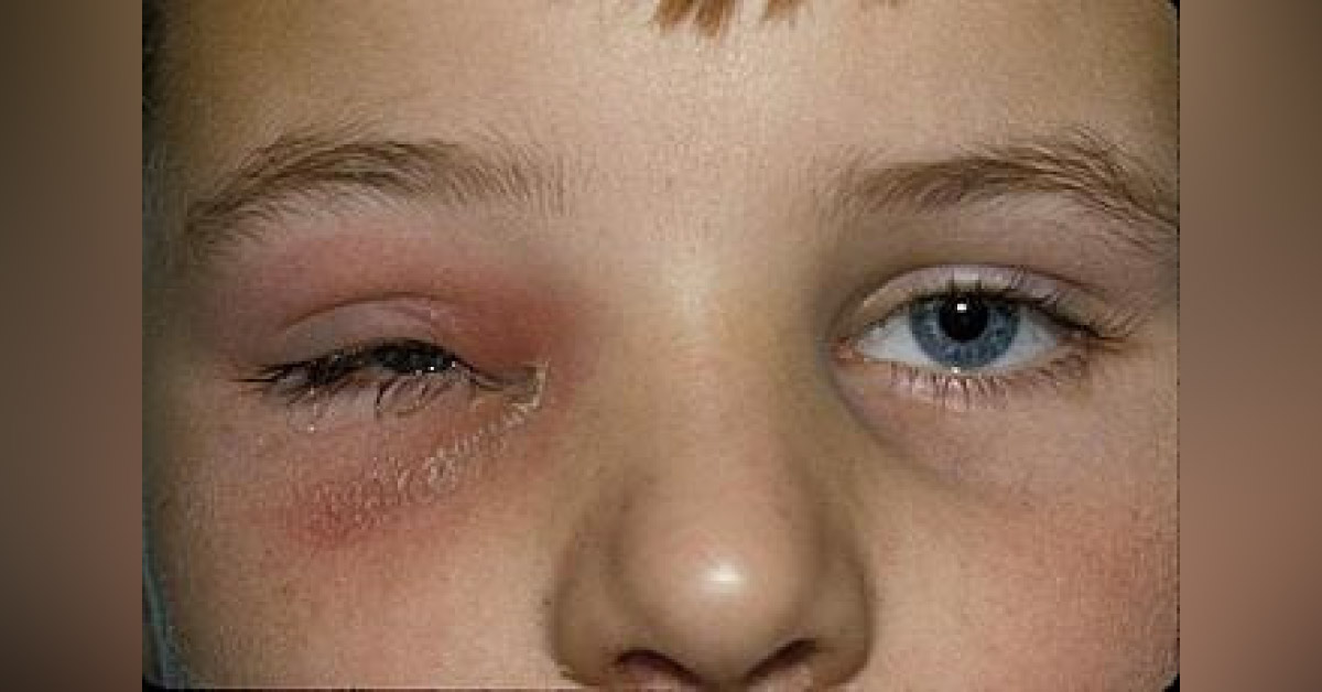 Importance Of Medial Wall Of Orbital