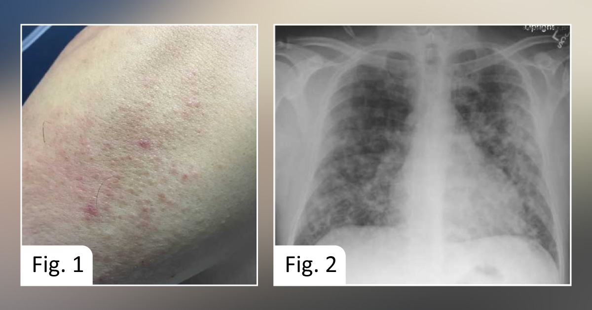 Worsening Dyspnea, Blood-tinged Sputum, and Weight Loss: Can You Identify the Chronic Cough Problem?