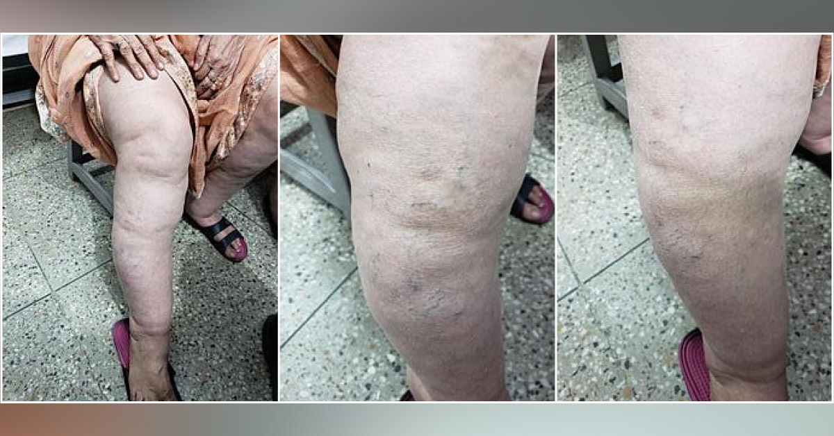 What Is This Fatty Puffiness And Fatty Lumps In Mother And Daughter?