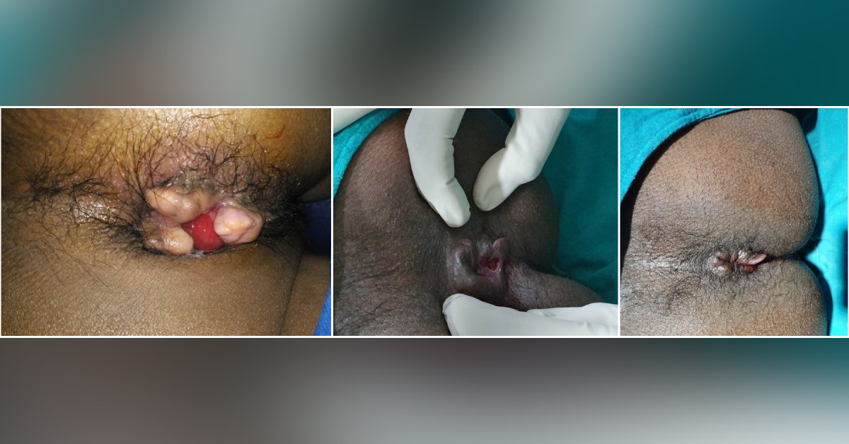 Laser Surgery In Anal Canal Disease