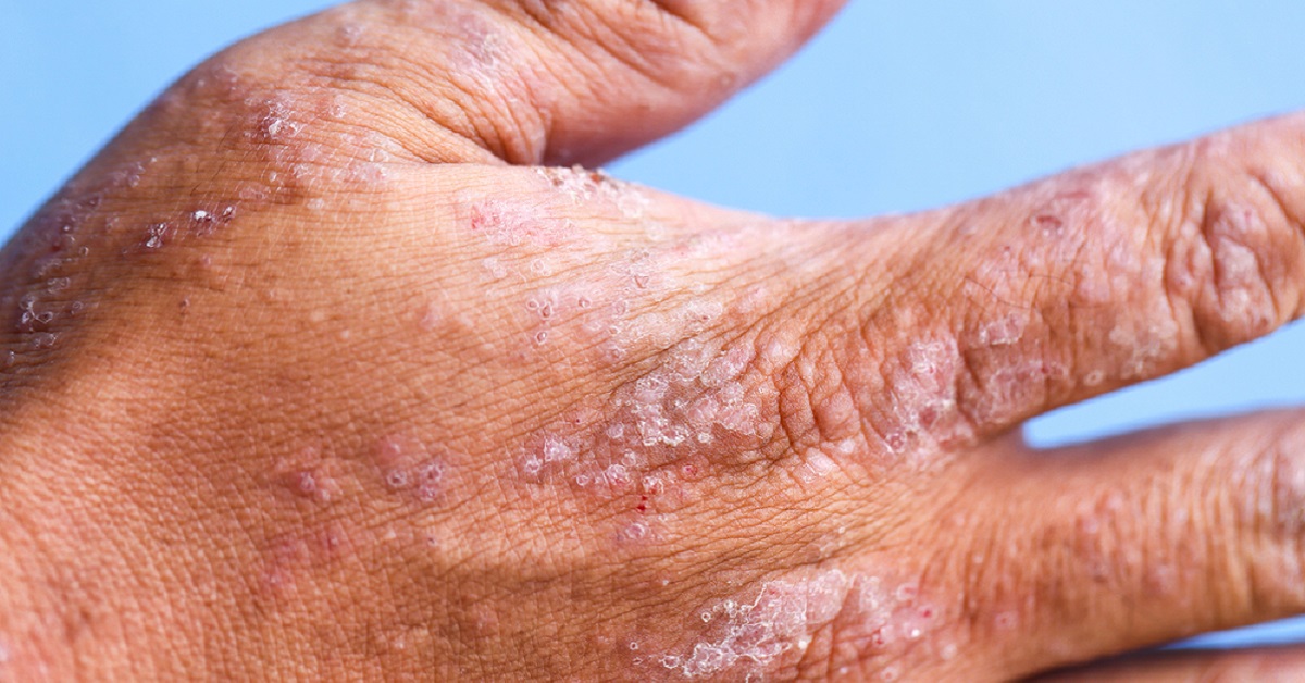Your Viewpoint On Management Of Atopic Dermatitis