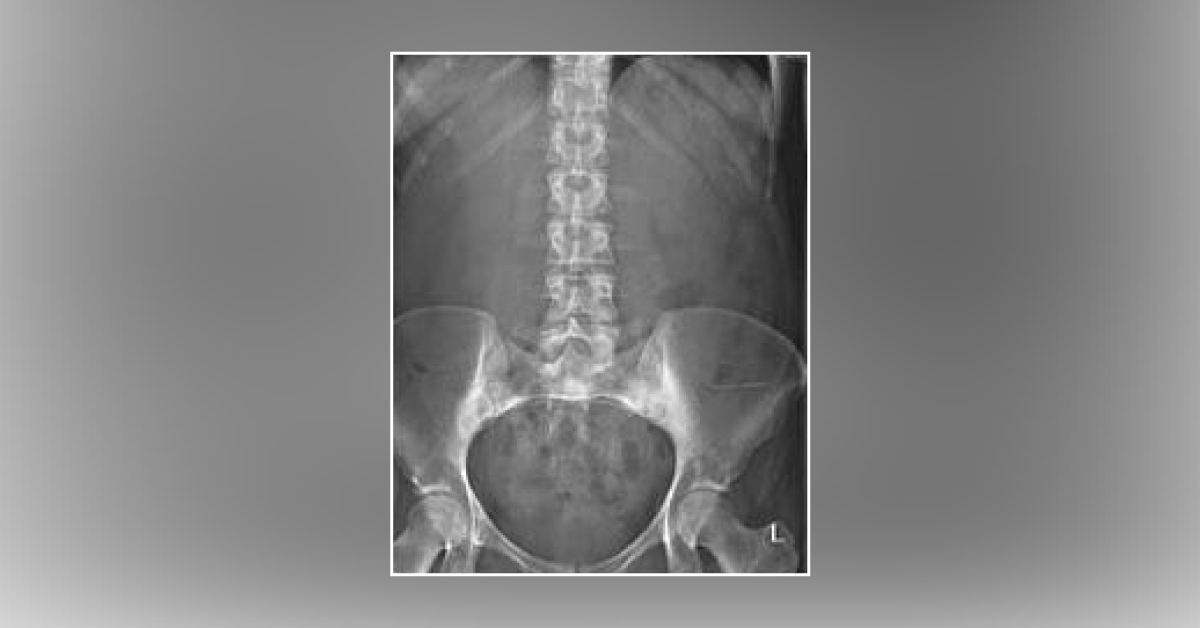 Case of Acute Abdominal Pain