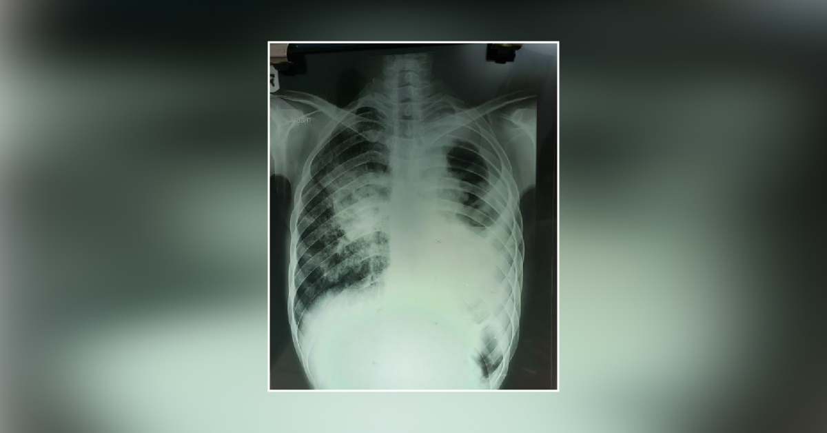 Silicosis With Three Infections
