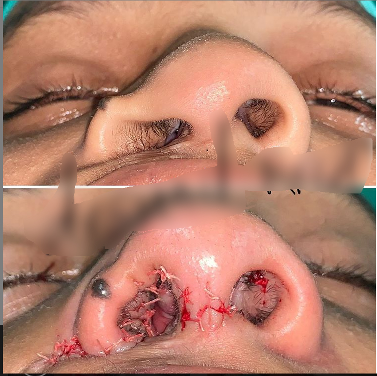 Before and after cleft nose surgery
