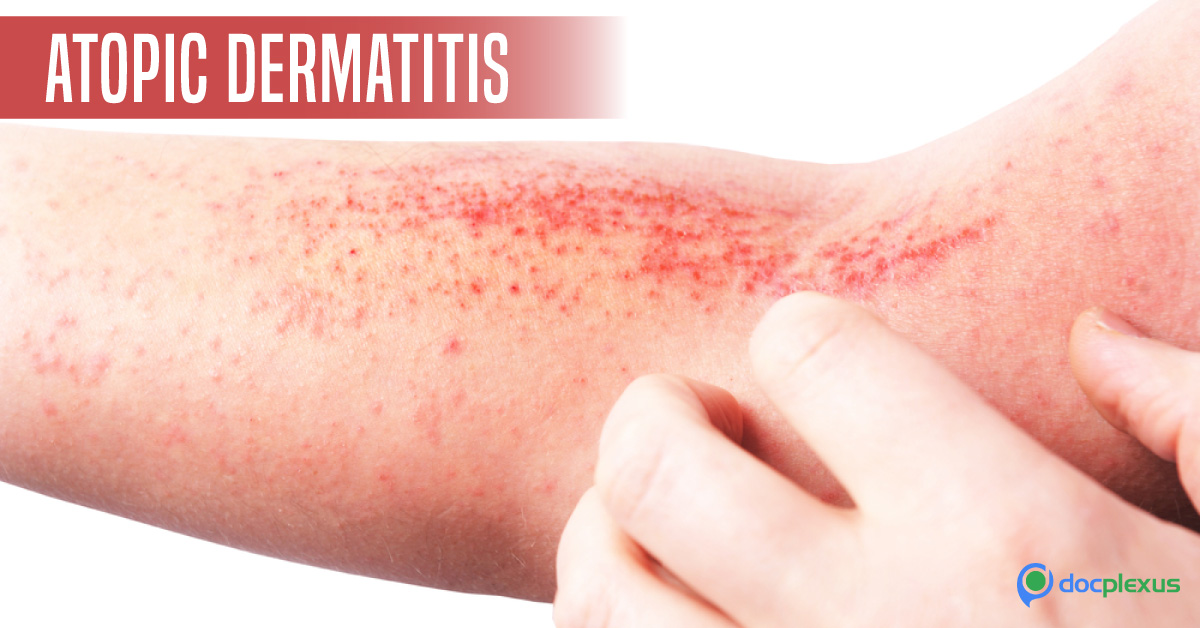 Atopic Eczema (Atopic Dermatitis) : European Academy of Dermatology and Venereology Guidelines (2018) Part 1