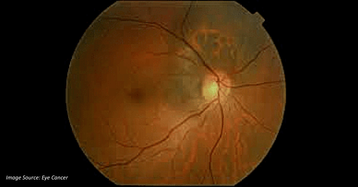 Diagnostic Modalities Of Choroidal Melanomas
