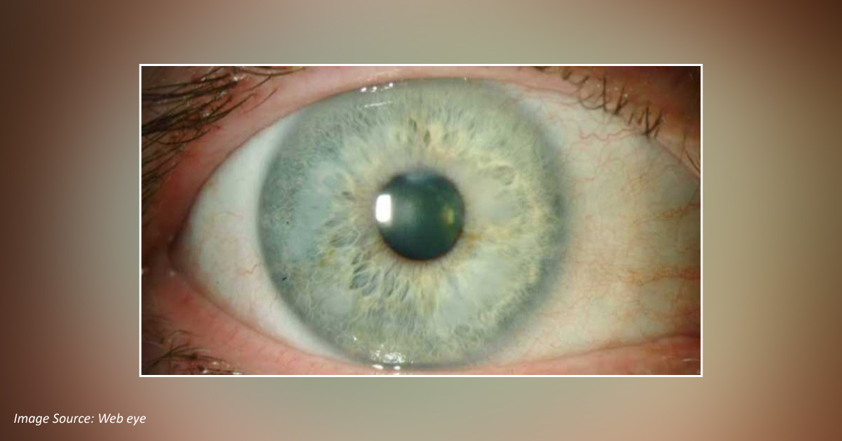 Causes of Salzmann's Corneal Degeneration