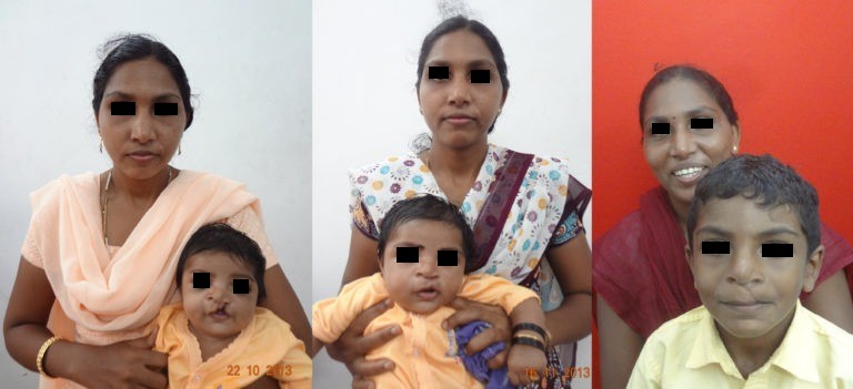 A Baby With Clef Llip And Palate To A Confident School Going Kid