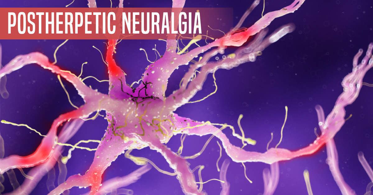 Postherpetic Neuralgia: A Complex Neuropathy
