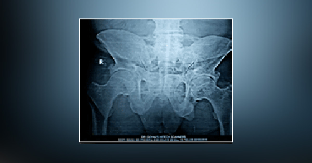 Are These Bone Cysts In 80 years Old Pelvic Bones?