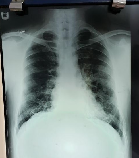 What Is The Cause Of Cough In This Patient?