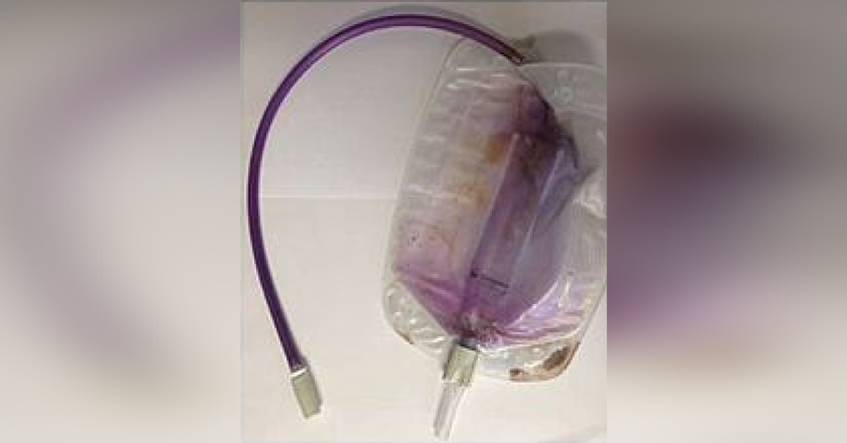 Why Does This Patient Have Purple Urine?