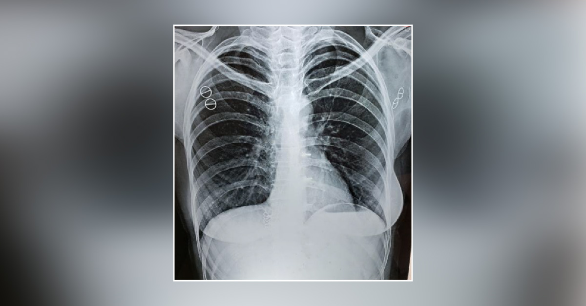 Comments On This X Ray Chest PA View?