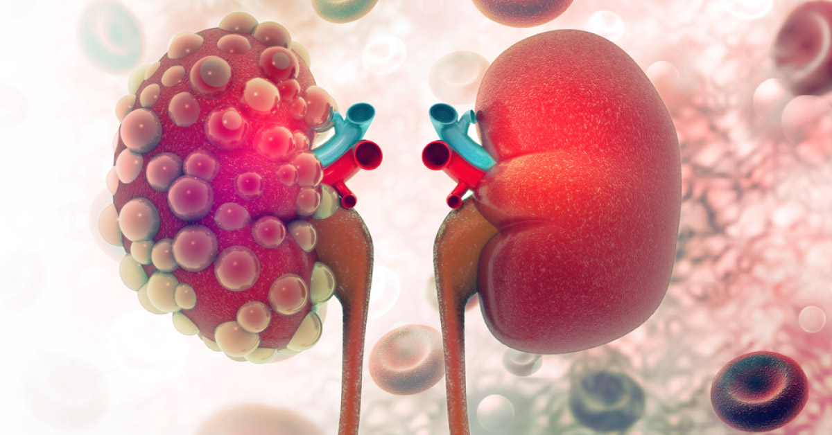 Prevalence of CKD: Where we are heading?