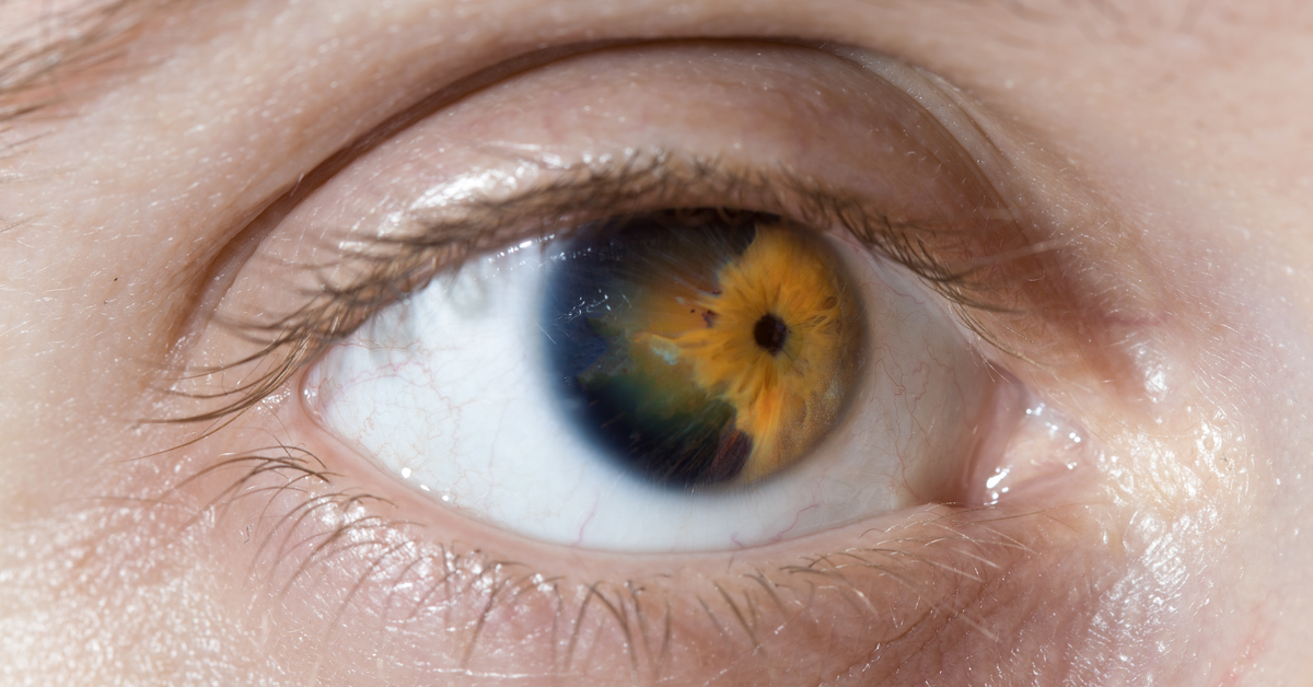 What Is Corneal Dystrophy?