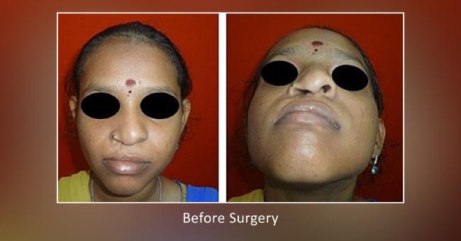 Cleft Nasal Deformity Correction at Richardsons Hospital