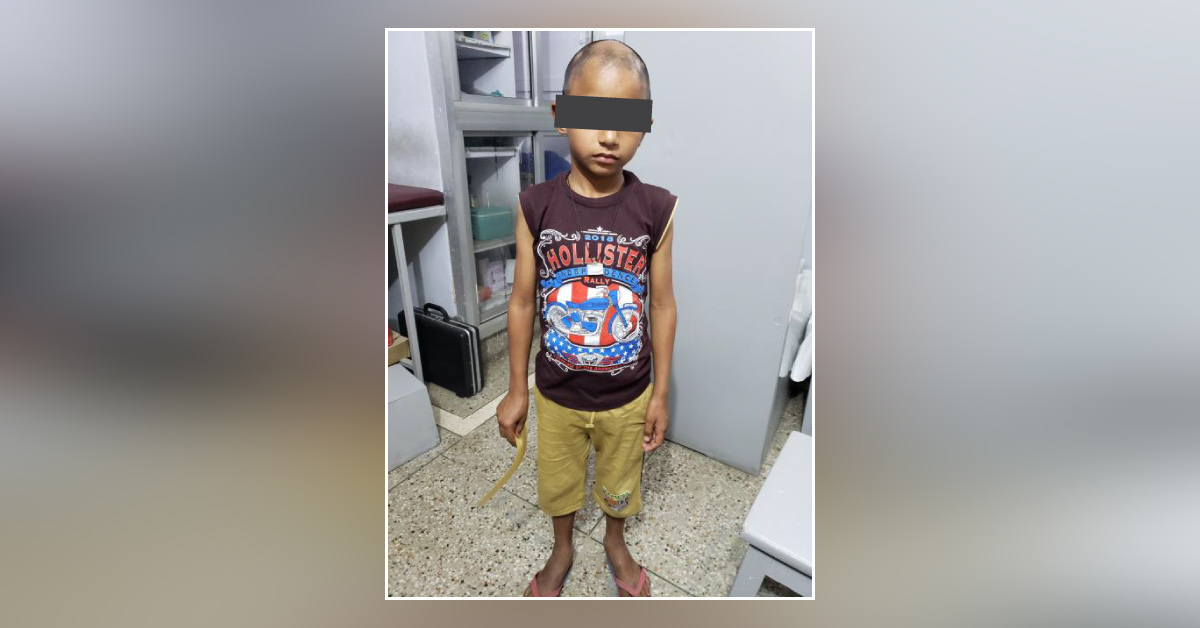 Both Malnutrition And Alopecia Areata Are Related?