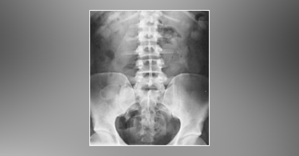 Cardiac Arrest at the Airport: Unique Case of a Pregnant Drug Peddler