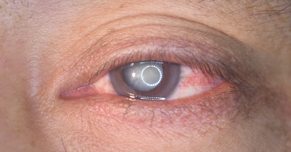 Some Causes Of Leukocoria