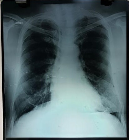 Non-pulmonary Disorder In This Xray Chest?