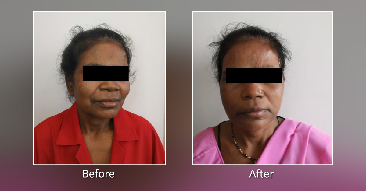Facelift Surgery In Mumbai