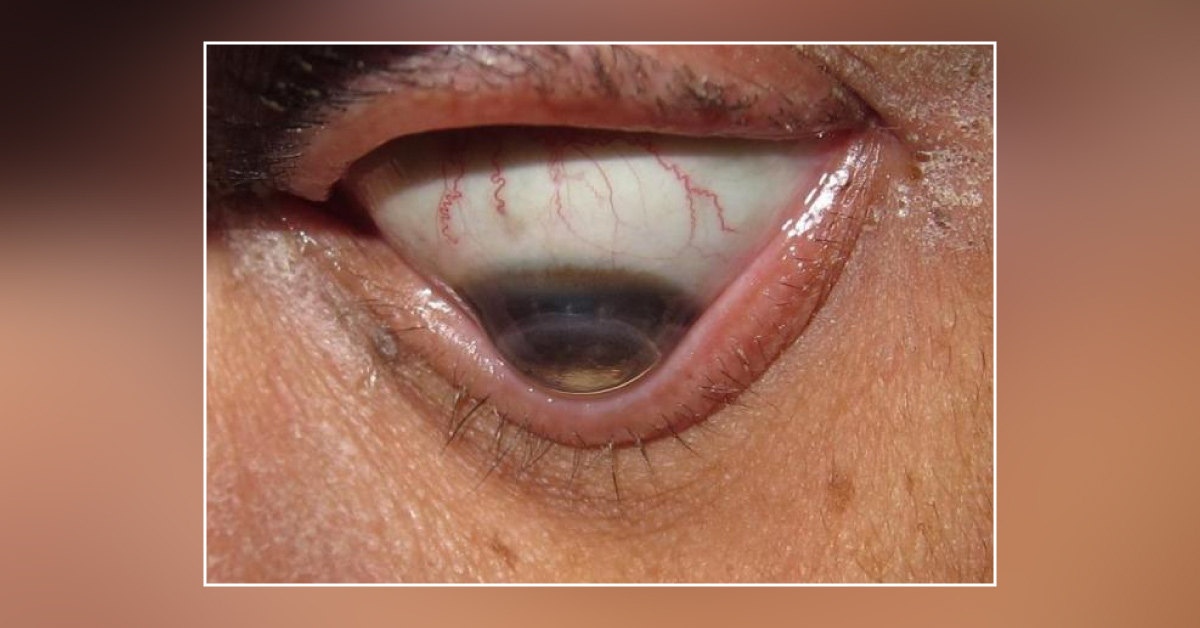 Cardinal Features Of Keratoconus
