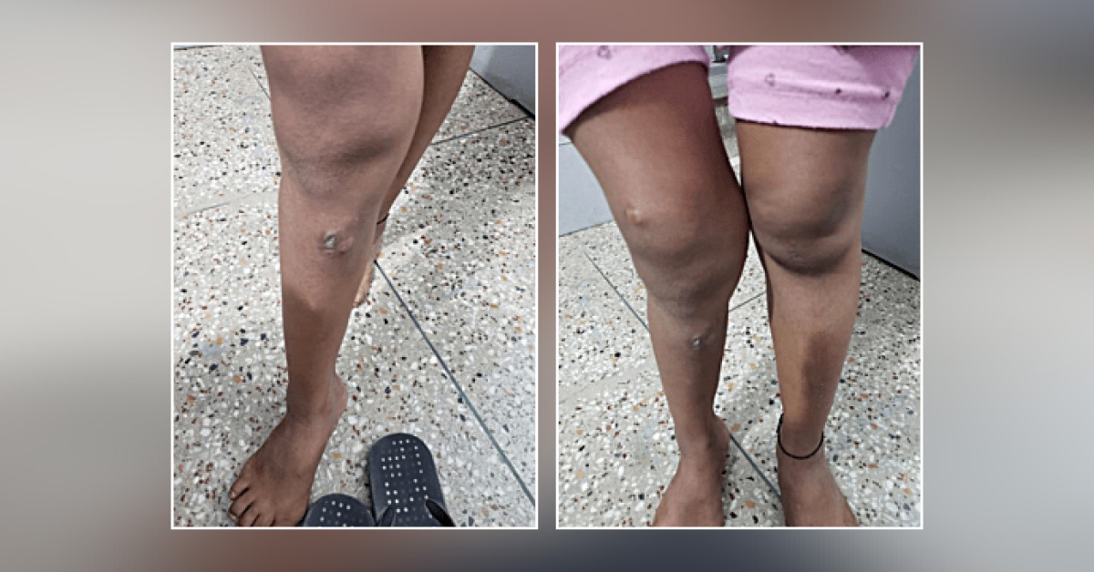 Osteomyelitis Due To Negligence!
