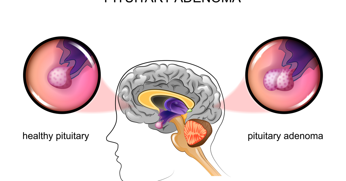 Brief Post On Field Changes Produced By Pituitary Adenoma