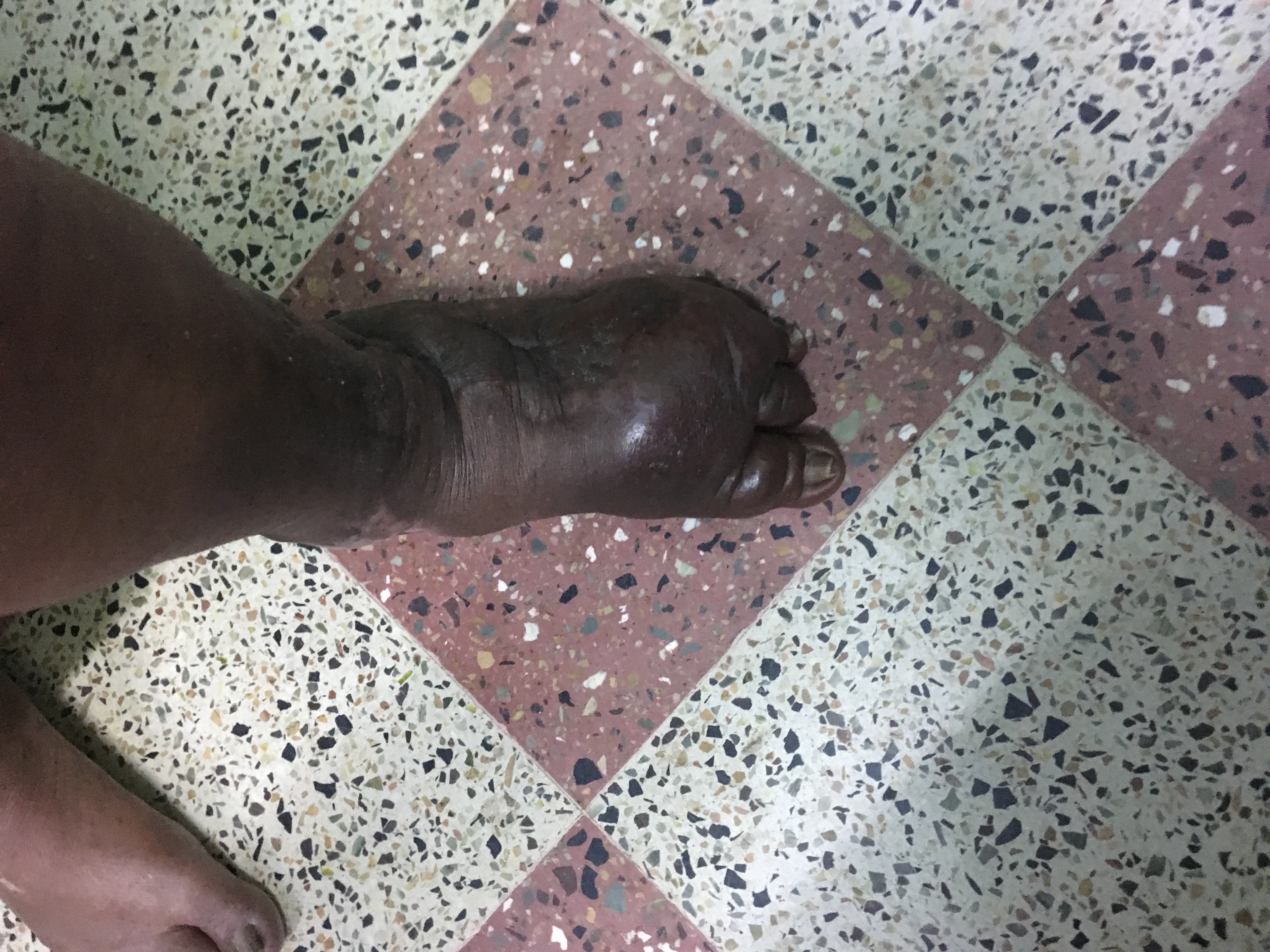 Unilateral Leg Swelling After Surgery- Think Of Lymphatic Ducts Disruption
