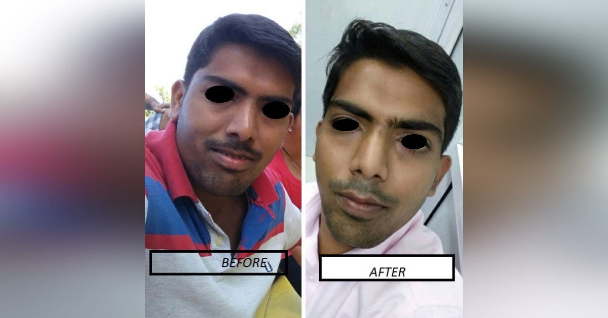 Facial Sculpting. Buccal Fat removal